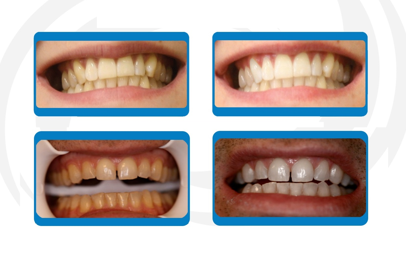 Whiten teeth efficiently with Power Swabs